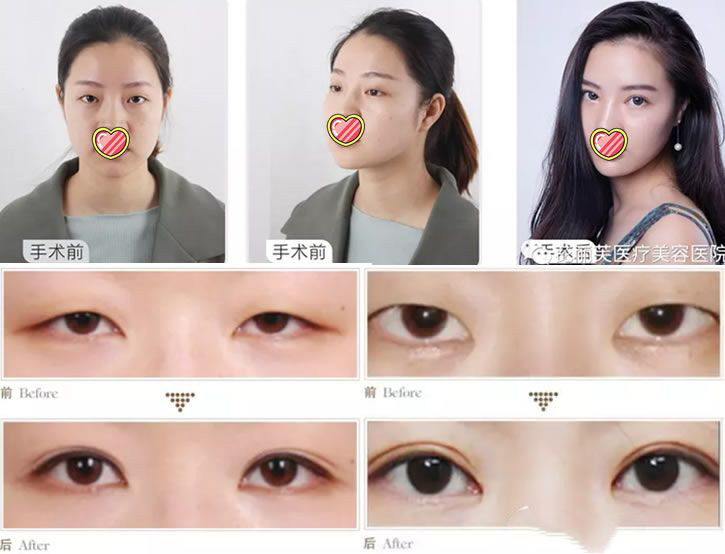 临安芘丽芙整形医院双眼皮案例