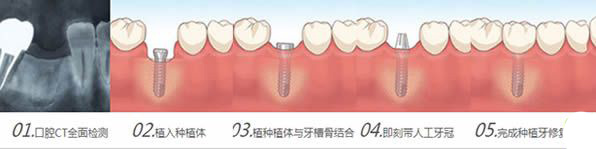 种植牙手术流程