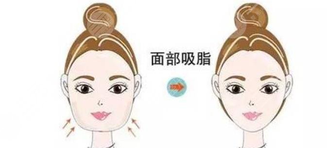 面部吸脂