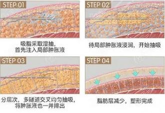 吸脂过程