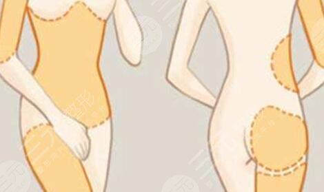 手臂吸脂