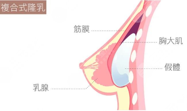 复合隆胸