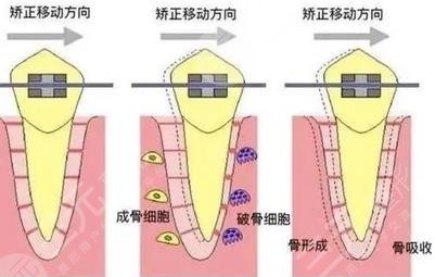 牙齿矫正