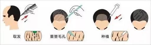 植发原理
