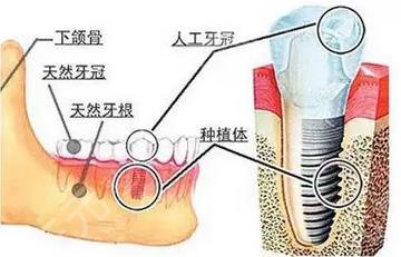 牙齿种植结构
