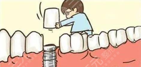 种植牙效果