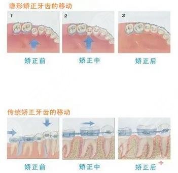 牙齿矫正