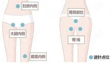珠海人民医院整形科吸脂减肥效果图