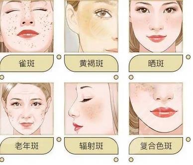 雀斑的类型特点