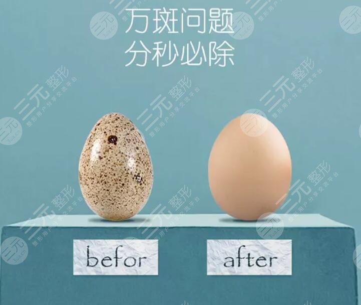 吉大二院点阵激光祛斑案例