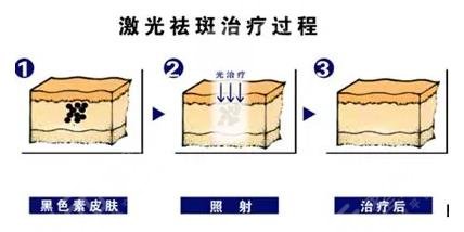 激光祛斑治疗过程