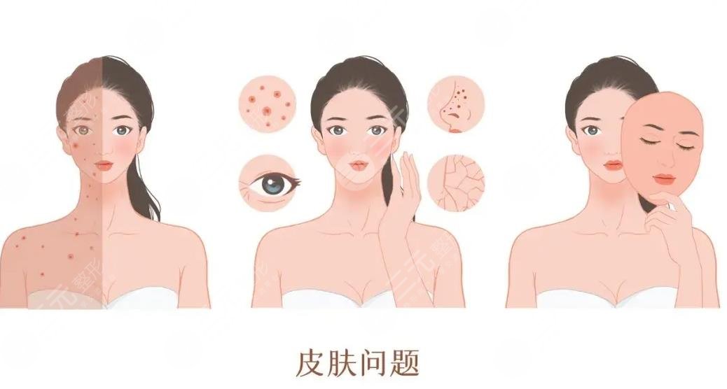 光子嫩肤项目
