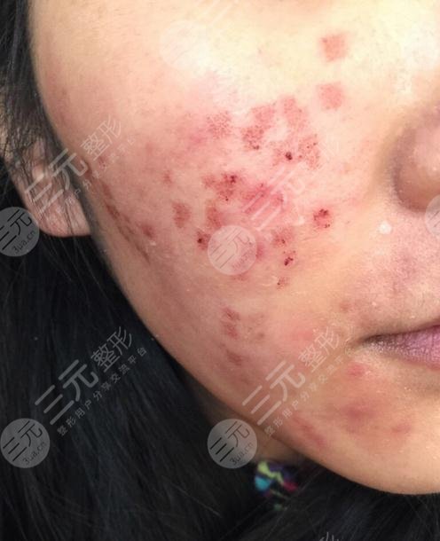广东省皮肤病医院点阵激光美容案例