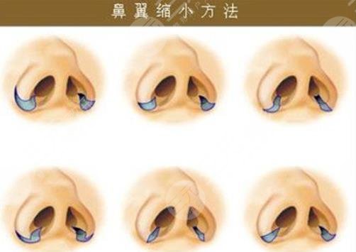 缩小鼻翼