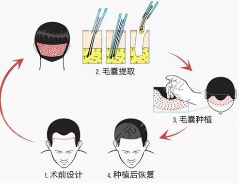 广州植发的价格一般是多少