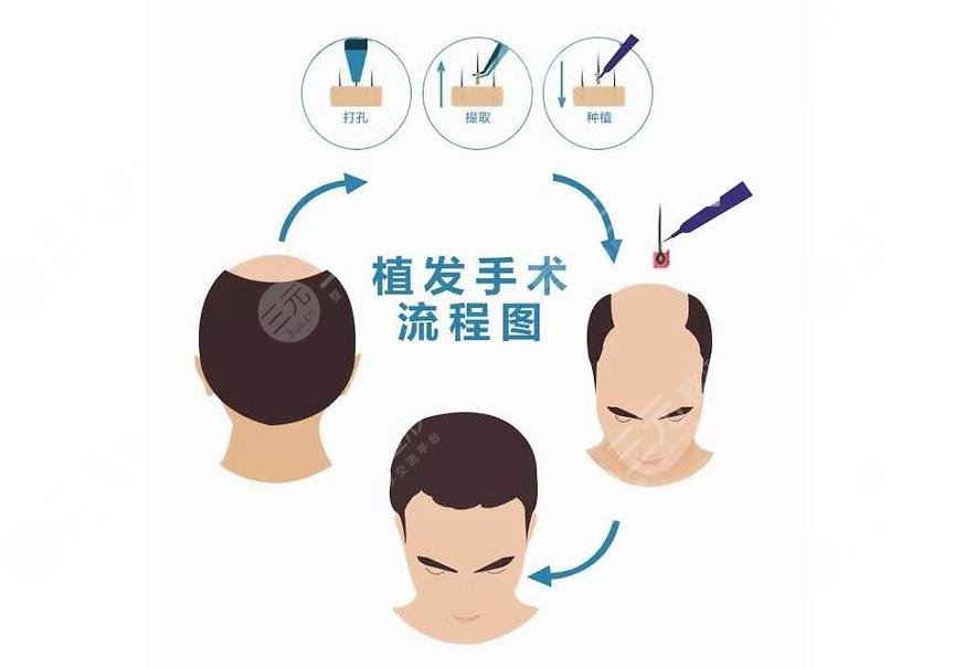 植发手术