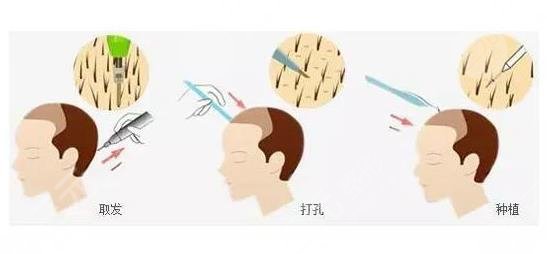 植发手术