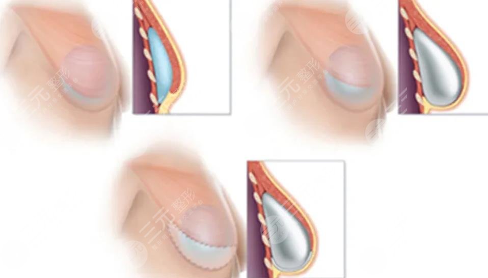 三,什么是乳房再造手术