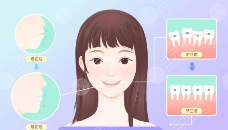 华西口腔牙齿矫正案例