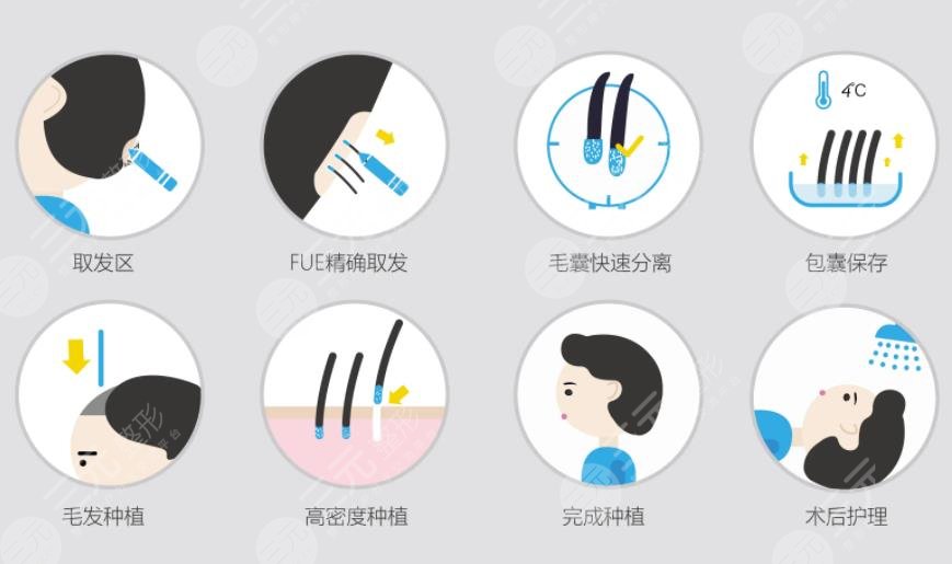种植头发手术案例