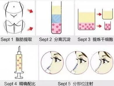 成都西区医院隆鼻特色项目