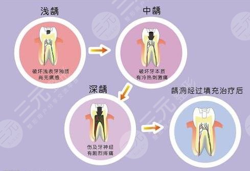 补牙多少钱一颗牙