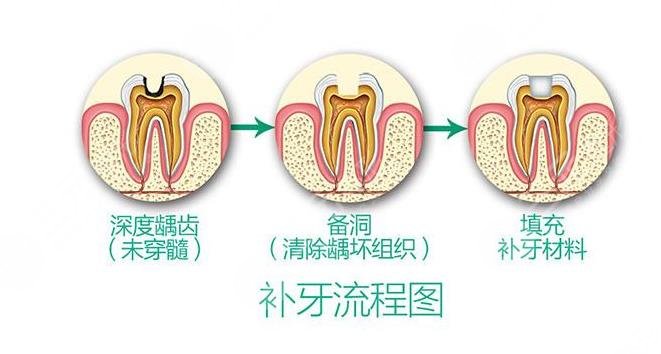 补一颗牙价格的影响因素