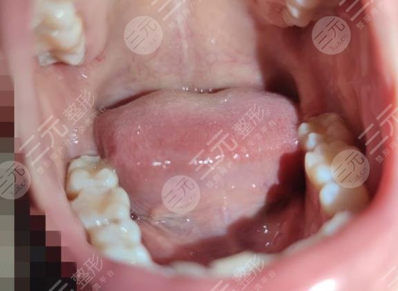 补完牙之后如何进行口腔护理