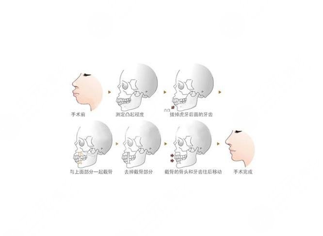 常熟二院口腔科牙齿矫正案例分享 、牙齿矫正前