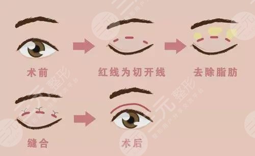 金皇后美容医院双眼皮手术案例