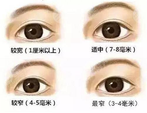 金皇后美容院双眼皮案例2