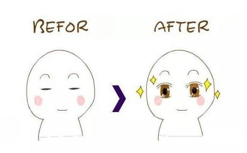 双眼皮整形手术