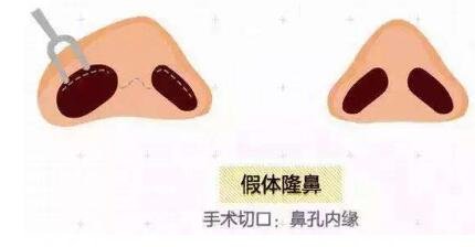 鼻翼整形手术安全吗?