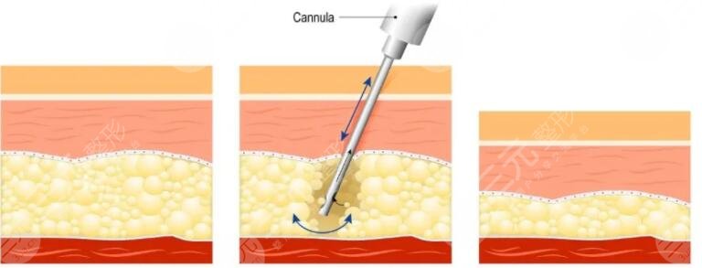 北医三院赵润蕾医生擅长项目