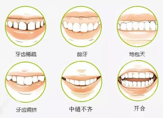 深圳市人民医院矫正牙齿真实案例反馈:术前