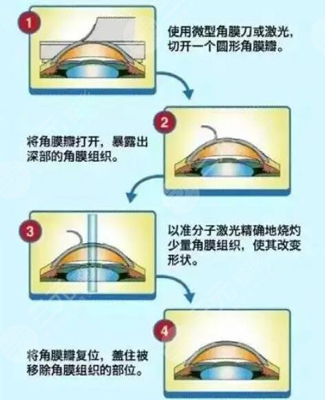 上海爱尔眼科相关项目科普