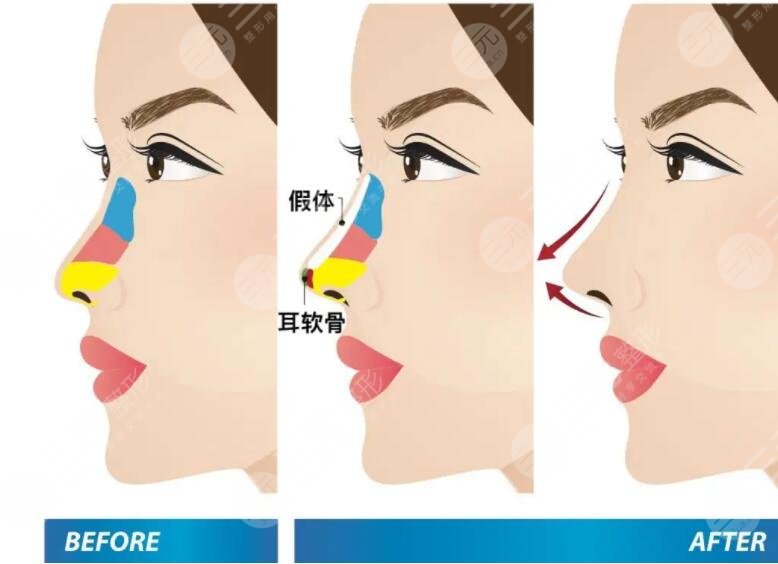 硅胶隆鼻