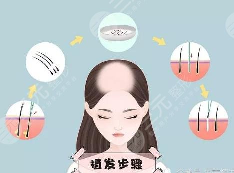 植发手术项目科普