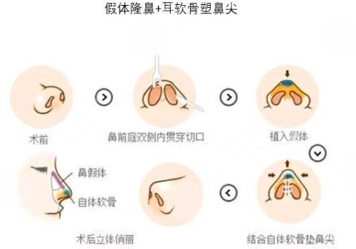 假体隆鼻
