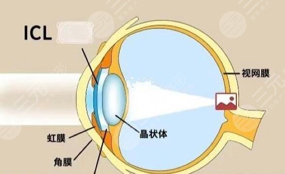 近视激光手术有哪些要求?