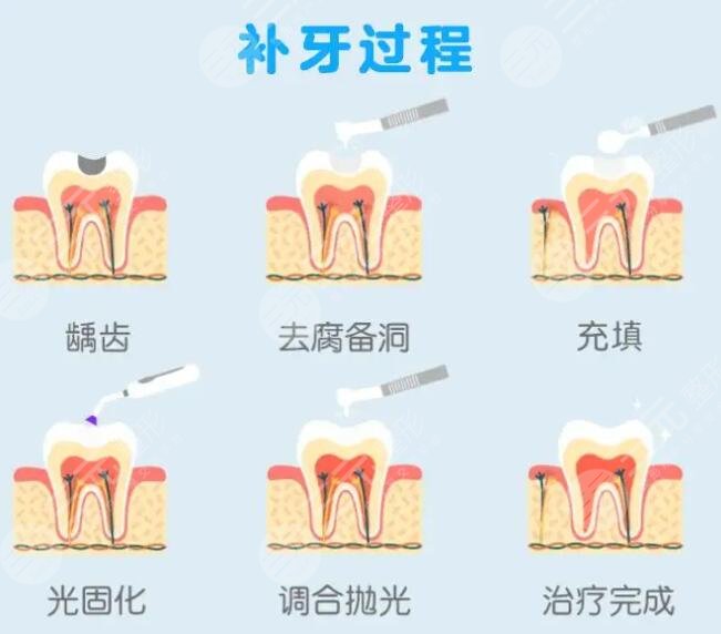 中山三院补牙项目科普