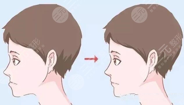 深圳市人民医院正颌手术案例