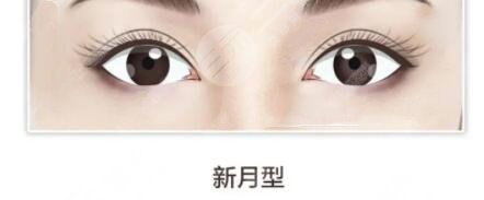 双眼皮是什么原理?