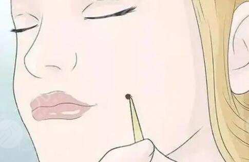 激光点痣如何操作?