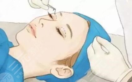 埋线双眼皮操作简单吗?