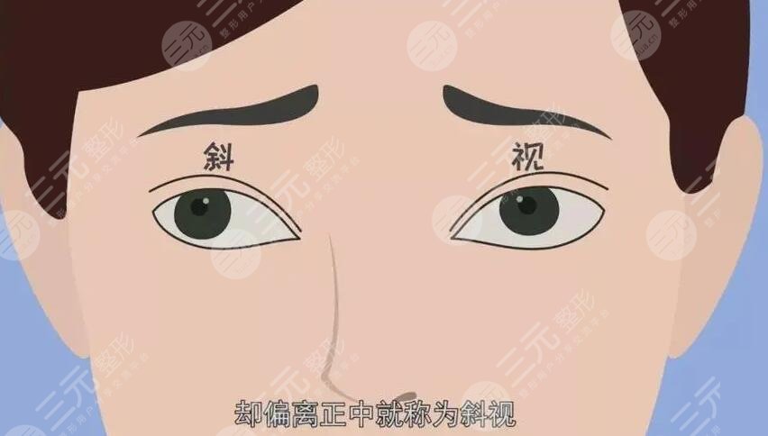 斜视手术是如何操作的?