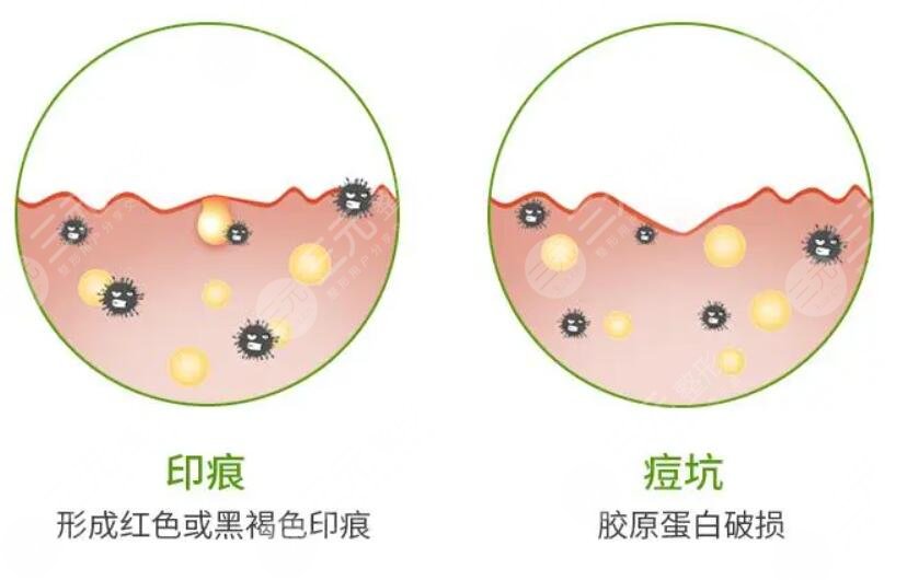 激光痘印操作的流程