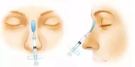 玻尿酸隆鼻