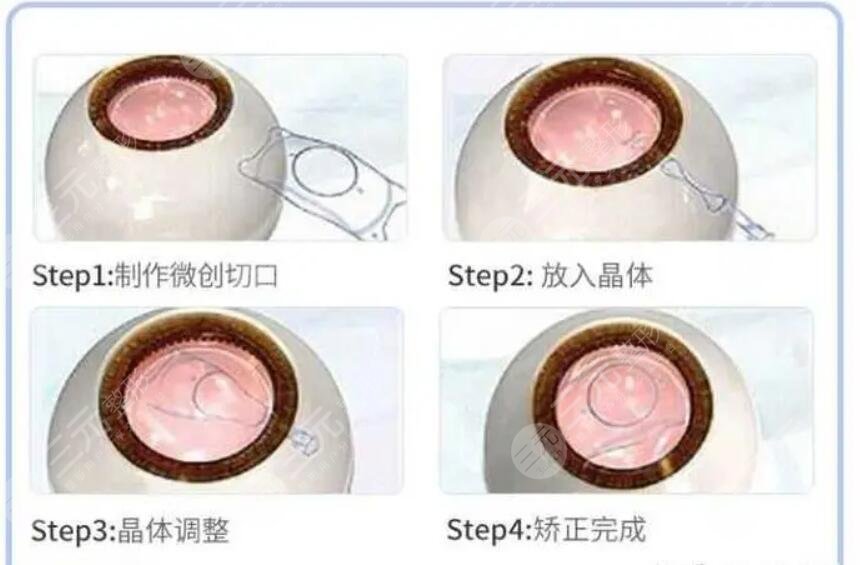 ICL晶体植入手术