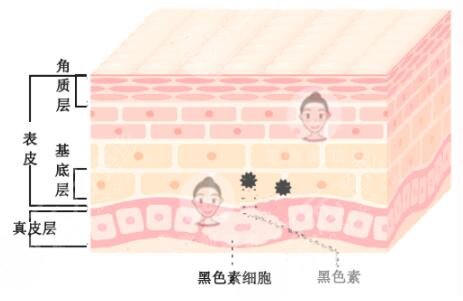 中山大学附属第三医院点阵激光祛斑案例